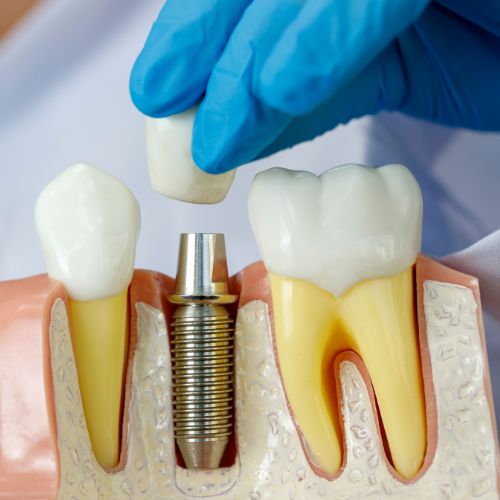 ZUBNI IMPLANTATI