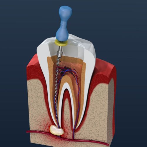 ENDODONCIJA